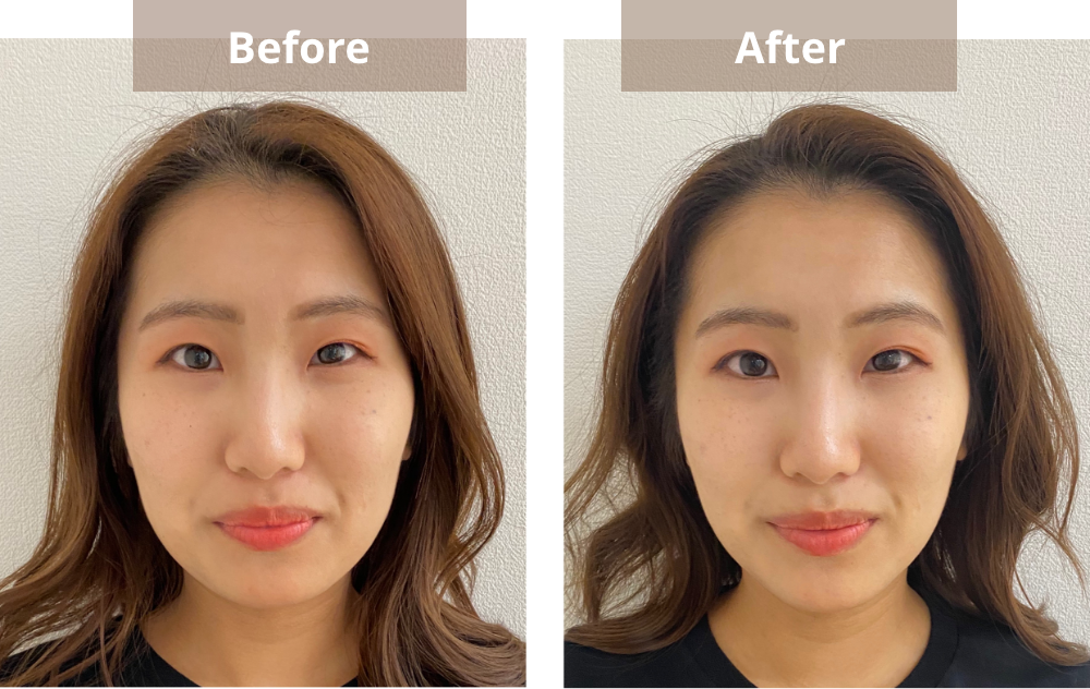 ビフォアーアフターの写真