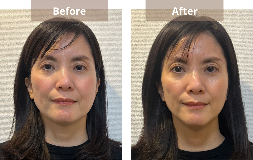 ビフォアーアフターの写真